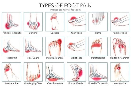 Different Types of foot pain that the best insoles for travel can help with