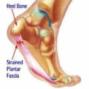 A diagram of plantar fascia tear