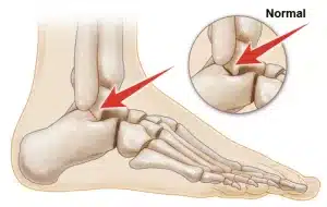 chart diagram of tarsal coalition a cause of foot pain