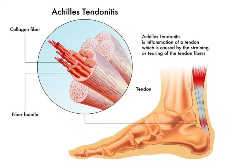 A chart diagraming the foot pain Achilles Tendonitis