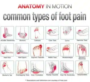 A chart diagraming the different types of common foot pain