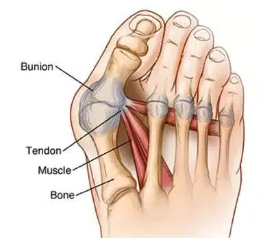 A chart of bunions and tailor's bunions that cause foot pain