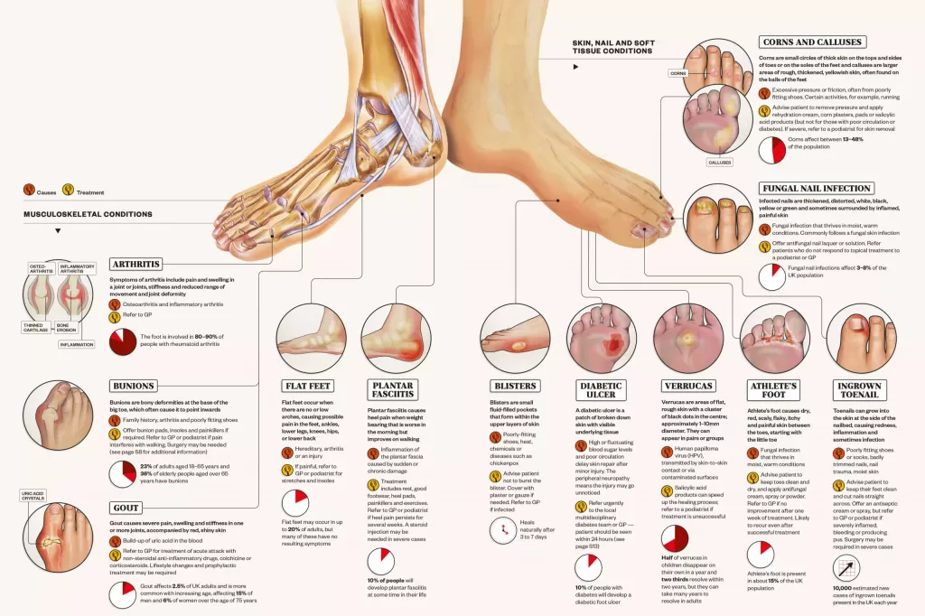 Diagram and Chart of different foot pain