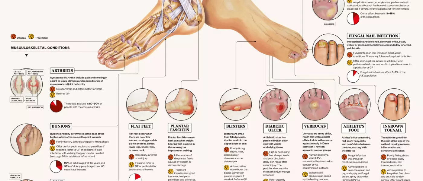 Diagram and Chart of different foot pain