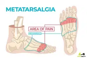 chart diagram of metatarsalgia, that causes foot pain 