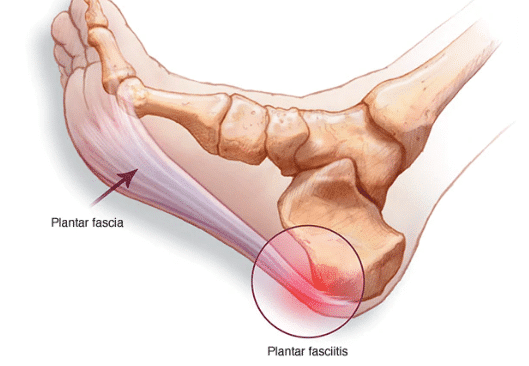 a diagram charting plantar fasciitis foot pain